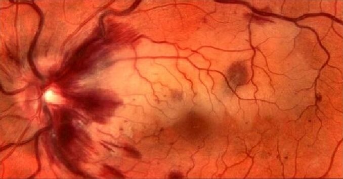 Vasos sanguíneos de la retina y la residualización de la visión